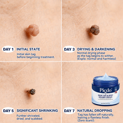 𝐏𝐢𝐜𝐝𝐨®🌈7-𝐃𝐚𝐲 𝐒𝐤𝐢𝐧 𝐓𝐚𝐠 & 𝐒𝐩𝐨𝐭 𝐄𝐫𝐚𝐬𝐞𝐫 𝐂𝐫𝐞𝐚𝐦(Zero Pain, Zero 𝐒𝐜𝐚𝐫𝐬 Formula)🎁