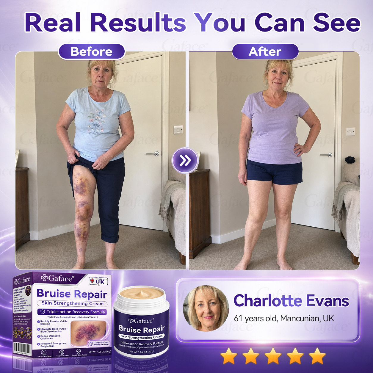𝑮𝒂𝒇𝒂𝒄𝒆®🛡️👩‍⚕️ 𝑩𝒓𝒖𝒊𝒔𝒆 𝑹𝒆𝒑𝒂𝒊𝒓 & 𝑺𝒌𝒊𝒏-𝑺𝒕𝒓𝒆𝒏𝒈𝒕𝒉𝒆𝒏𝒊𝒏𝒈 𝑪𝒓𝒆𝒂𝒎