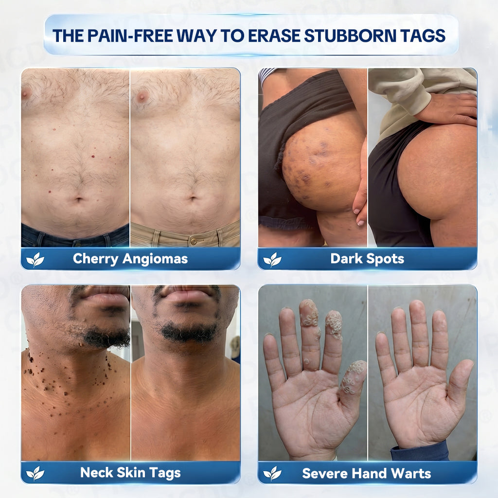 𝐏𝐢𝐜𝐝𝐨®🌈7-𝐃𝐚𝐲 𝐒𝐤𝐢𝐧 𝐓𝐚𝐠 & 𝐒𝐩𝐨𝐭 𝐄𝐫𝐚𝐬𝐞𝐫 𝐂𝐫𝐞𝐚𝐦(Zero Pain, Zero 𝐒𝐜𝐚𝐫𝐬 Formula)🎁