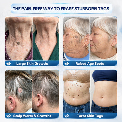 ✨🐉𝐏𝐢𝐜𝐝𝐨® 7-𝐃𝐚𝐲 𝐒𝐤𝐢𝐧 𝐓𝐚𝐠 & 𝐒𝐩𝐨𝐭 𝐄𝐫𝐚𝐬𝐞𝐫 𝐂𝐫𝐞𝐚𝐦🩵 (Zero Pain, Zero 𝐒𝐜𝐚𝐫𝐬 Formula)