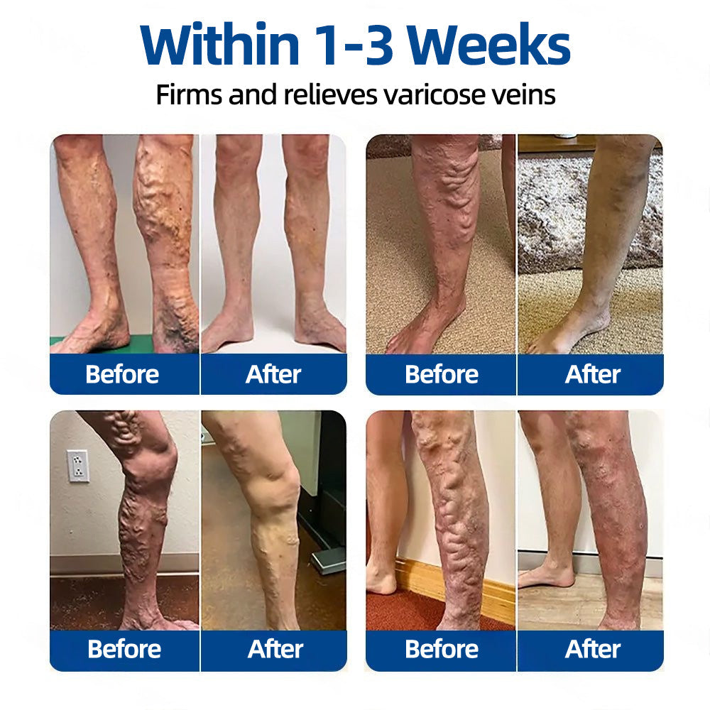 💧💧𝐅𝐥𝐨𝐫𝐢𝐬𝐦𝐚®✅𝐕𝐞𝐢𝐧𝐓𝐚𝐫𝐠𝐞𝐭 𝐌𝐢𝐜𝐫𝐨𝐧𝐞𝐞𝐝𝐥𝐞 𝐏𝐚𝐭𝐜𝐡⚡Instant Relief, Long-Term Results