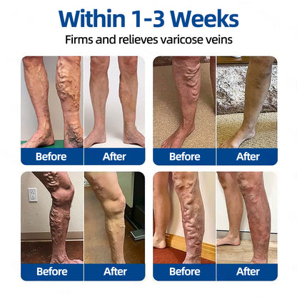 💧💧𝐅𝐥𝐨𝐫𝐢𝐬𝐦𝐚®✅𝐕𝐞𝐢𝐧𝐓𝐚𝐫𝐠𝐞𝐭 𝐌𝐢𝐜𝐫𝐨𝐧𝐞𝐞𝐝𝐥𝐞 𝐏𝐚𝐭𝐜𝐡⚡Instant Relief, Long-Term Results